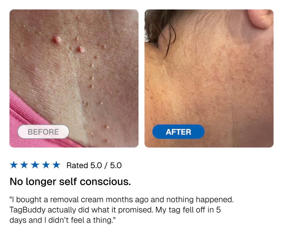 GlowMax™ TagStrike - Skin Tag Removal Kit