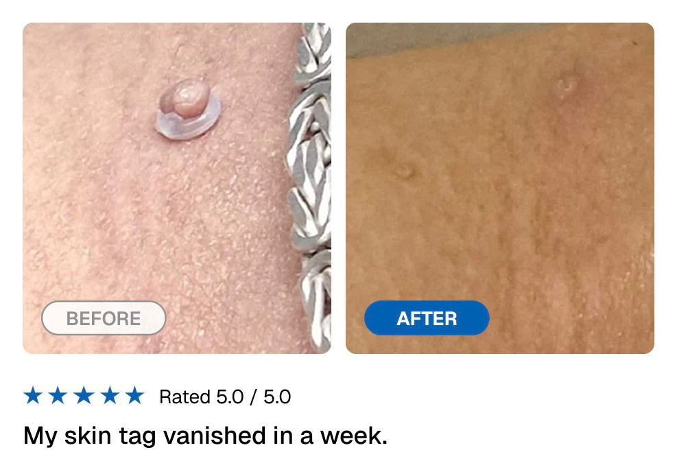 GlowMax™ TagStrike - Skin Tag Removal Kit