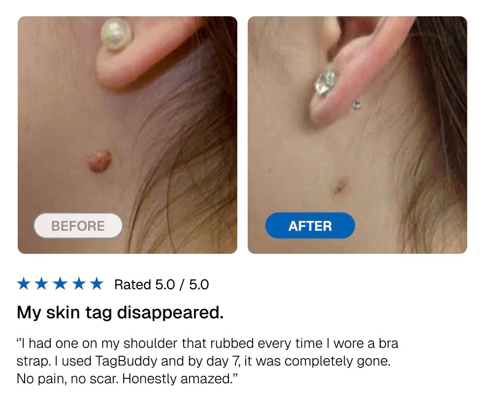 GlowMax™ TagStrike - Skin Tag Removal Kit